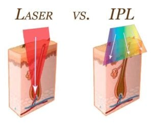 Skillnaden mellan laser och IPL
